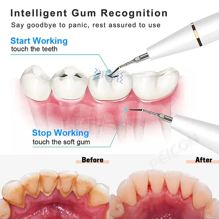 Ultrasone Tandenreiniger - SonicClean